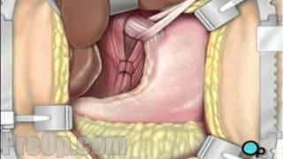 Hernia - Hiatal Open Repair Surgery PreOp® Patient Education