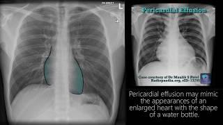 Radiograph Tutorial: Chest X-ray / CXR | Radiology Nation