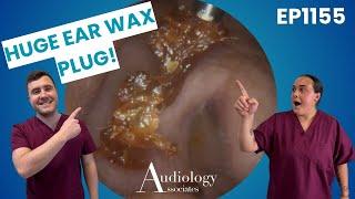 Deep Ear Wax Removal with Microsuction – Super Satisfying! - EP1155