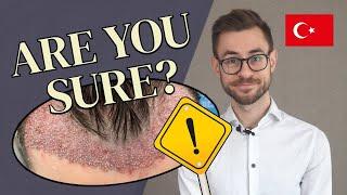 Hair Transplant in Turkey: A Warning From An Expert [2023]