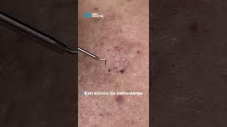 Extracción de comedones (puntos negros) | Skin Hospital | #puntosnegros