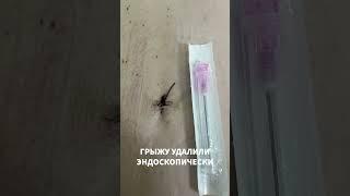 Эндоскопическое удаление грыжи диска