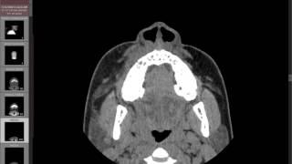 Odontogenic sinusitis