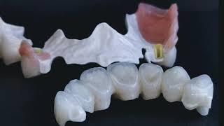 BioHPP/Peek  Removable Partial Denture | Zirconia frame + E.max Ceram Layering #BioHPP #PEEK #RPD