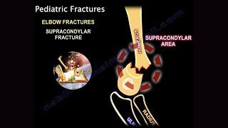 Pediatric Supracondylar Fractures of the humerus   Everything You Need To Know   Dr  Nabil Ebraheim