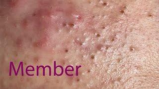 Acne Treatment Huong Da Nang#001 MEMBER  | 2023