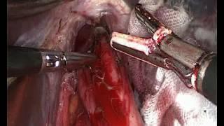 Laparoscopic Heller Myotomy for Achalasia of the cardia by Wael Tobar MD