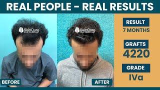 Hair Transplant in Delhi | Best Results | Hair Transplant cost in Delhi | Dr Jangid