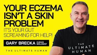 Why Your Eczema Isn’t Just Skin Deep...Here’s the REAL Cause! | TUH #176