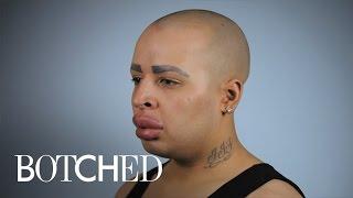 Can "Botched" Doctors Help Patient With Ginormous Lips? | E!