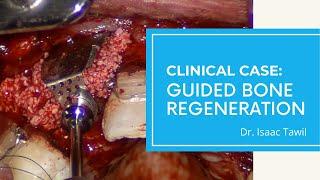 Guided Bone Regeneration (Anterior) Using i-Gen Membrane by Dr. Isaac Tawil