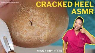 Exploring the Mythology of the Cracked Heel ASMR ||  Miss Foot Fixer