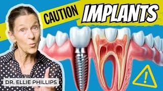 The Risk of Dental Implants