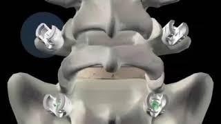 Orthofix: Firebird Spinal Fixation System