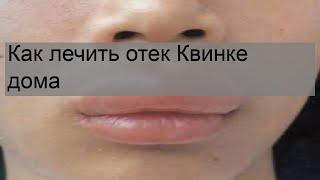 Как лечить отек Квинке дома