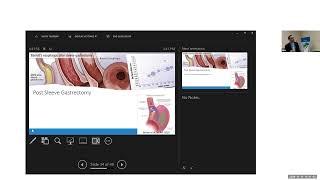 Managing Acid Reflux with Transoral Incisionless Fundoplication (TIF). B. Qumseya, M.D., UF Health