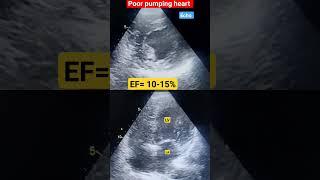 Poor pumping heart l EF- 10-15% #echo #shorts