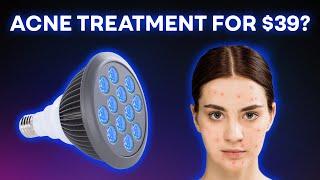 Hooga Blue Light Therapy Review: Handheld Acne Buster