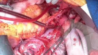 lt thoracotomy Total Arch Replacement + aberrant rt SCA reattach