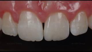 Реставрация переднего зуба. Замена старой пломбы. Front tooth restoration.