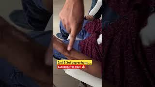 Burning Area inspection ...... #burning #wound #Treatment #ytshortsvideo