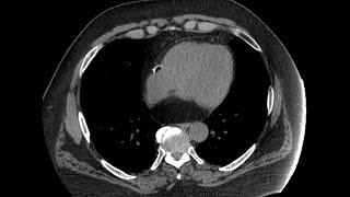 STR Cardiothoracic Case Webinar 1/28/2020