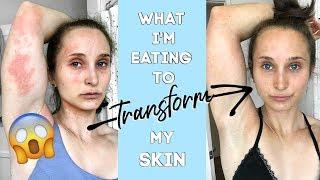 What I Eat to Fix My Skin & Heal My Gut | AIP RECIPES (The Autoimmune Protocol)