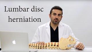 Lumbar Disc herniation | lumbar hernia | lumbar fusion | back pain | lumbar disc |