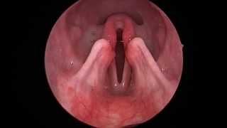 Dog: Lar Par (Laryngeal paralysis observed in sedated canine oral exam)