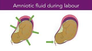 Amniotic Fluid During Labour