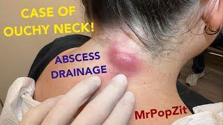 Great example of loculated (multi pocket)abscess! I push through the basement membrane & strike oil!