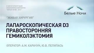 Мастер класс "Живая хирургия": лапароскопическая D3 правосторонняя гемиколэктомия