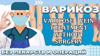 VARICOSE - TREATMENT WITHOUT SURGERY.