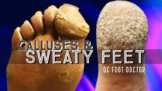 Calluses & Sweaty Feet: Work-Related Issues