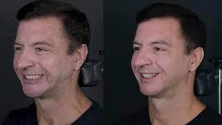 Aesthetic improvement of the lower face and neck - Supplementary video [ID 405639]