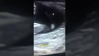 Sonography, Clubfoot in a 18 weeks fetus