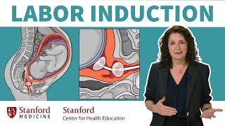 What is labor induction? OB/GYN answers 5 common questions about inducing labor | Stanford