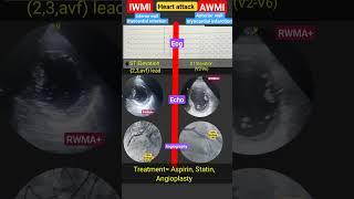 Heart attack l AWMI l IWMI l #ecg #echo #angiography #shorts