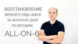 Восстановление верхнего ряда зубов за несколько дней по методики all-on-6