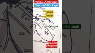 Proximal and distal LAD blockage l Major and minor heart  attack #heartattack #shorts Part-2