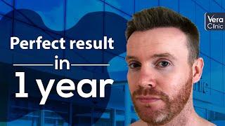 The Perfect Hair Transplant Result of Dean O'Connor - Sapphire FUE at Vera Clinic