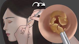 【ASMR animation】Massive Ear Wax removal 丨Meng's Stop Motion