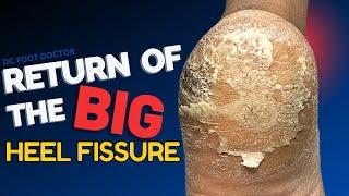 Return of the Big Heel Fissure