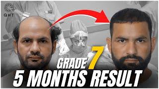 Bald To Bold Hair Transplant Journey || 6,761 Grafts || QHT || NW Garde VII ||  @Regrow Clinic