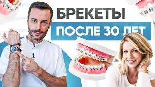 Брекеты после 30 лет. Когда уже поздно ставить брекеты?