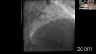 Best Practices in Cath Lab Management for STEMI