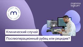 Клинический случай: “Послеоперационный рубец или рецидив?”