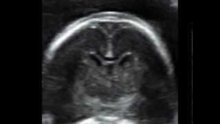 How to image the fetal corpus callosum