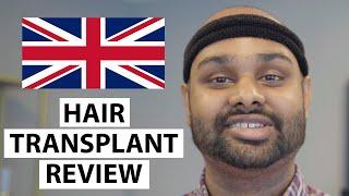 HELLO UK! Ramkumar’s Hair Transplant Experience at AEK Hair Clinic