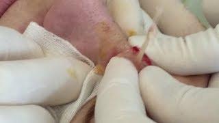 Squeezing pimple , cyst, boil!! Брызгающий Прыщ фурункул!!!